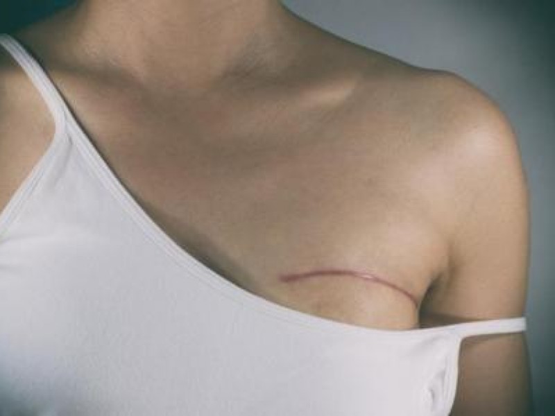 1 de cada 8 mujeres puede tener cáncer de mama:OMS