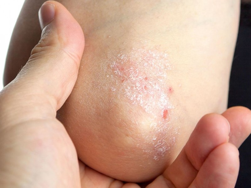 2.7 millones de mexicanos padecen psoriasis SSJ