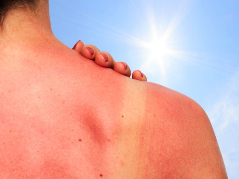 30 minutos de exposición al sol para quemarnos la piel
