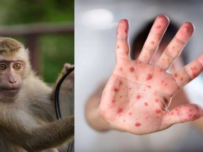 Hay 35 casos de viruela del mono en México