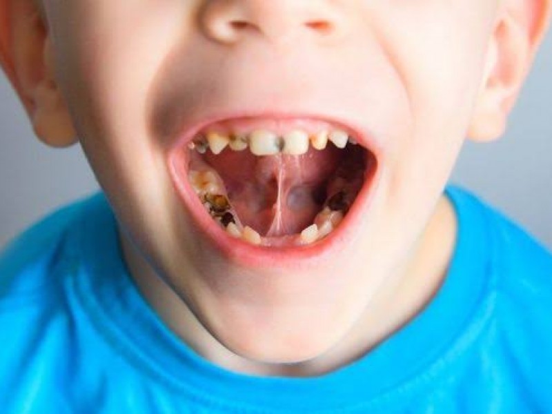 60% de niños mexicanos padecen de caries