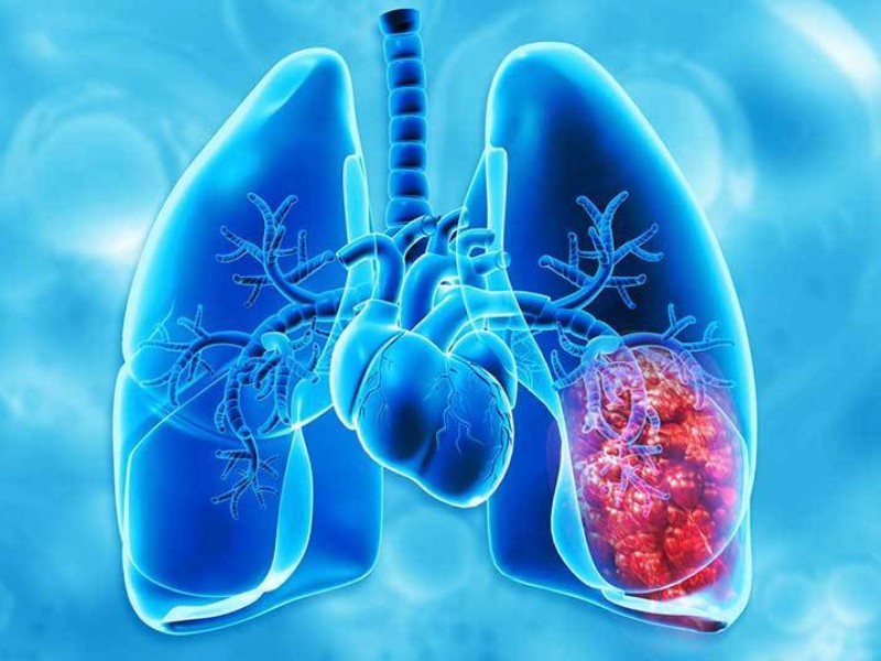 80% de personas que mueren por EPOC, desconocían su padecimiento