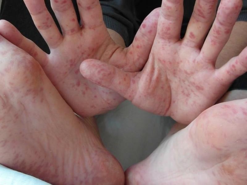 Alerta salud por virus de coxackie para mantenerse alerta de síntomas