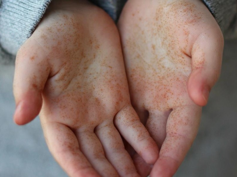 Llama Salud Estatal a estar atentos por virus de “Coxsackie” en escuelas