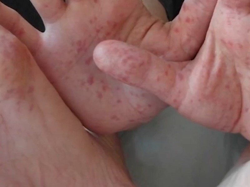 Alertan por brotes de virus Coxsackie en preescolares de Zihuatanejo