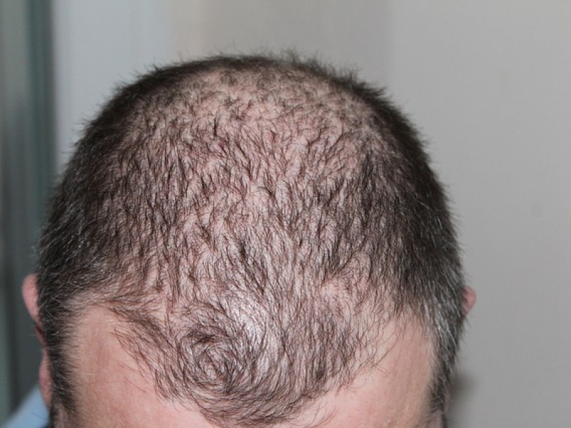 Alopecia por estrés afecta a mexicanos