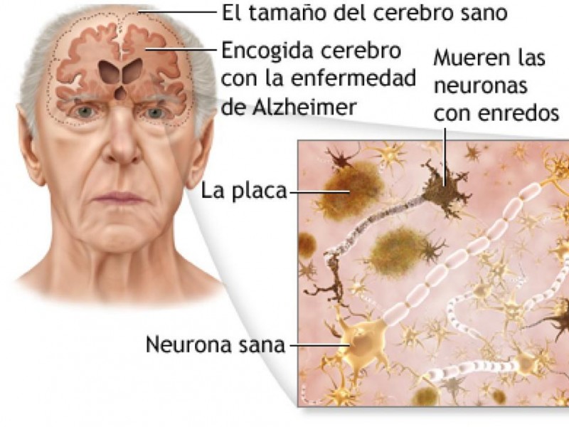 Alzheimer, la enfermedad de los adultos mayores