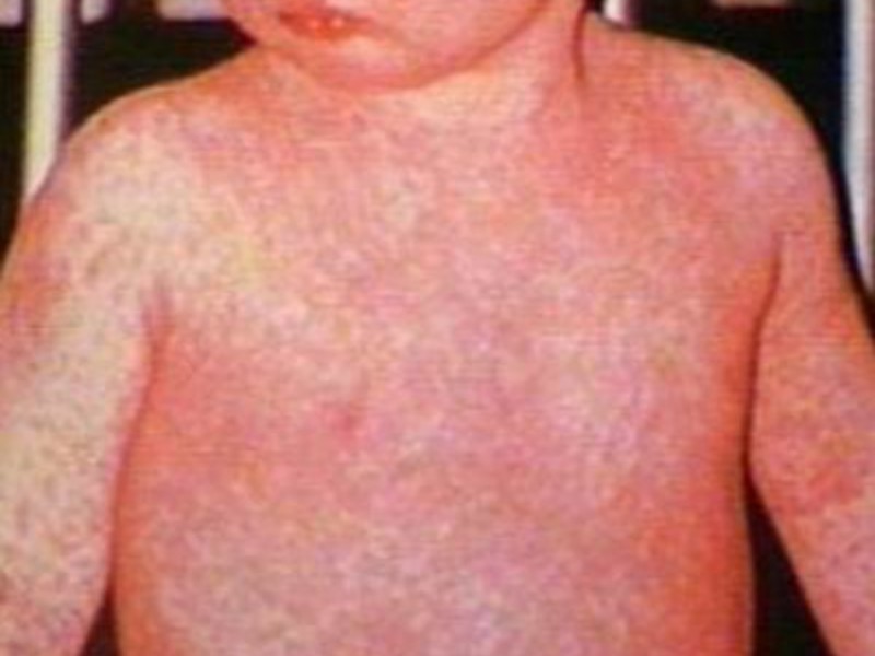 América ya no es zona libre de sarampión