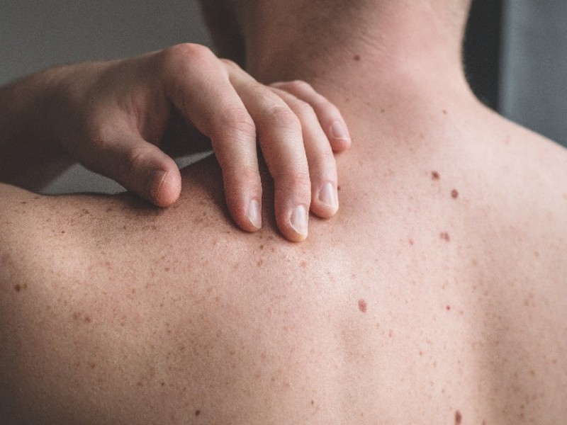 Aumenta cáncer en la piel entre menores de 40 años