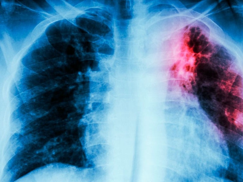 Aumenta mortalidad por Tuberculosis en Chiapas