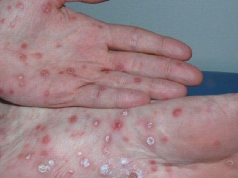 Aumentan 46% los casos de sífilis en Querétaro; reportan 305 contagios