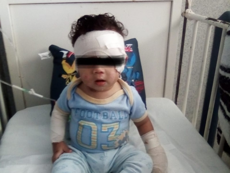 Bebé de 10 meses permanece hospitalizado por quemaduras