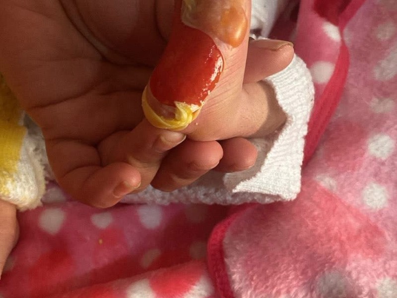 Bebé sufre quemadura durante prueba del tamiz en hospital comunitario de Guadalupe