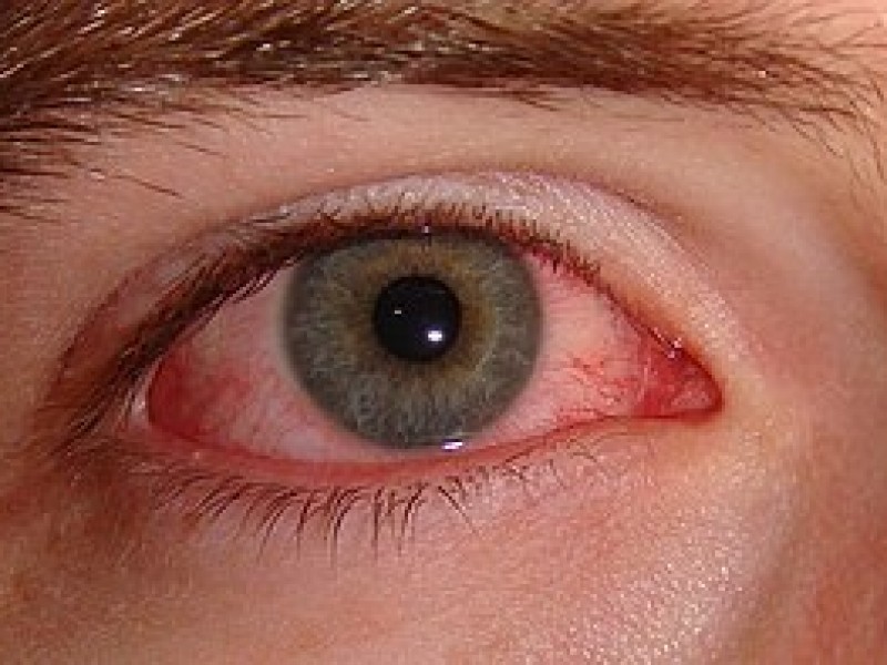 Calor también puede provocar infecciones en los ojos