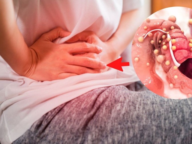 Cáncer de colon: una enfermedad silenciosa que se puede prevenir
