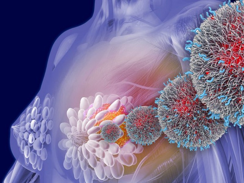 Cáncer de mama: principal causa de muerte por tumores malignos en mujeres