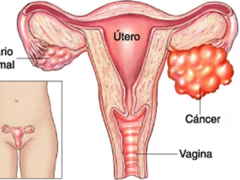 Cáncer de ovario, quinto lugar en mortalidad