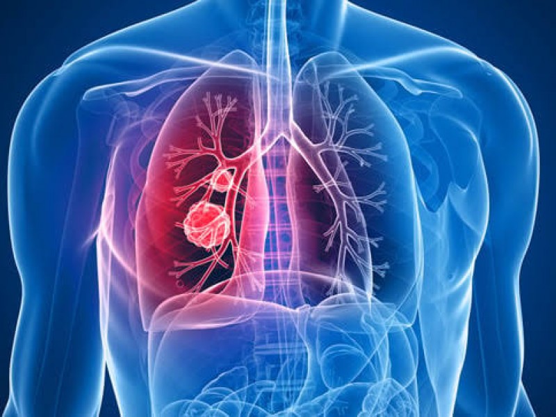 Cáncer de pulmón podría provocar muerte de 160.000 latinoamericanos