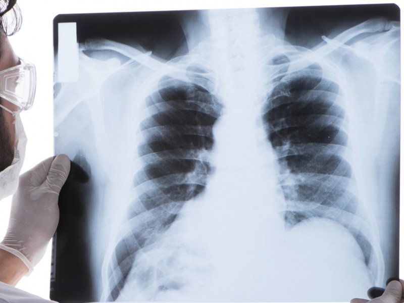 Cáncer y enfisema pulmonar: padecimientos posibles de fumadores pasivos