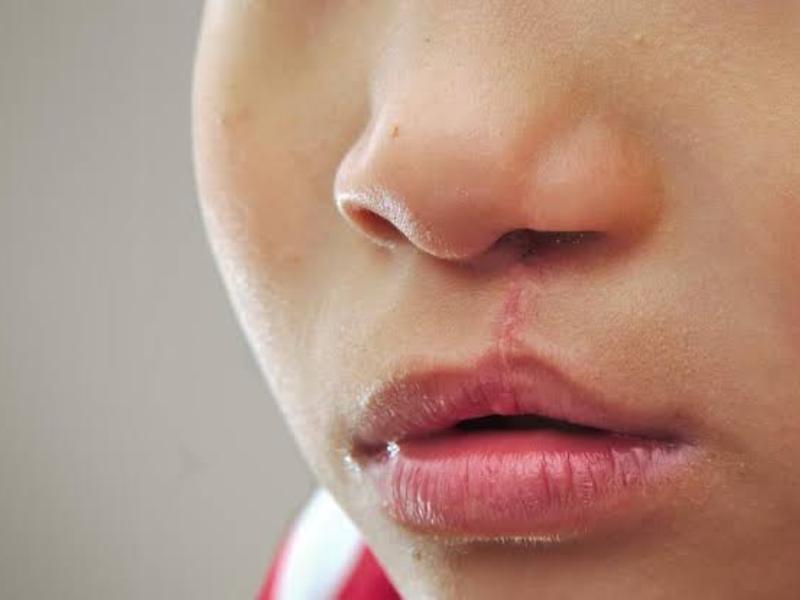 Chiapas, con mayor casos de labio y paladar hendido