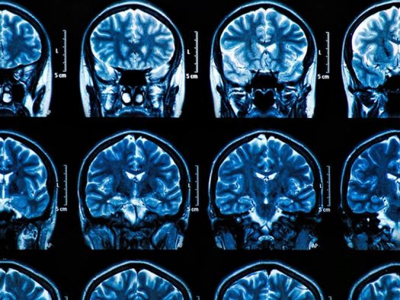 Científicos descubren que SARS-COV-2 causa graves afectaciones a células cerebrales