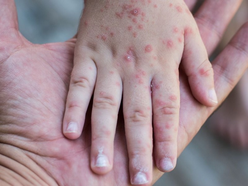 Confirman 18 casos de virus Coxsackie en Durango