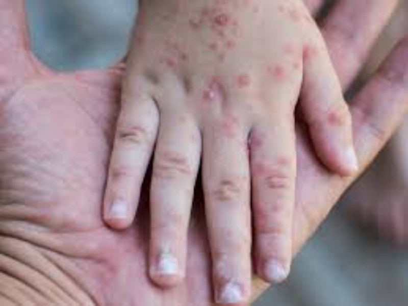 Confirman 25 casos de coxsackie en San Juan del Río