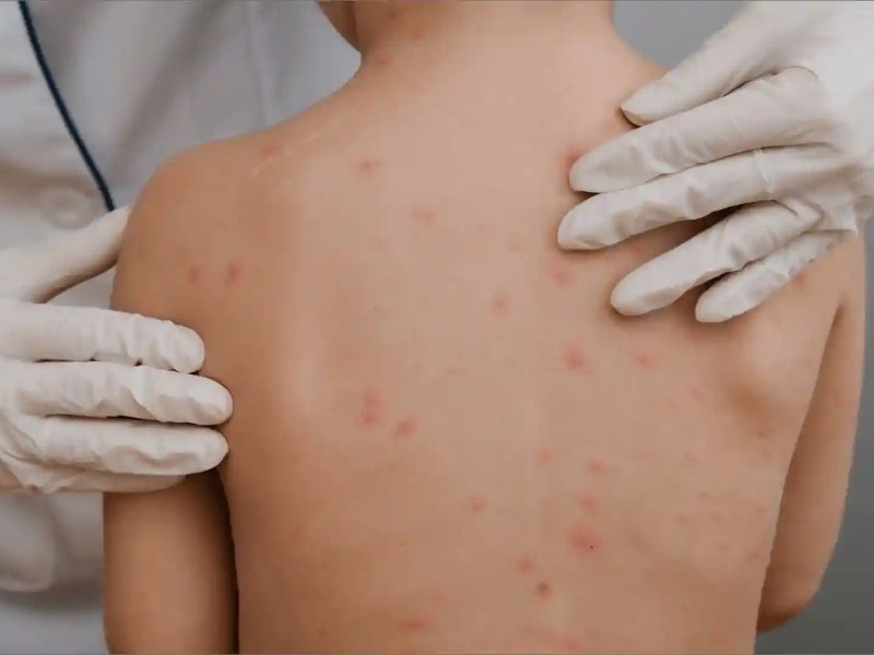 Confirman brote de varicela en secundaria de Hermosillo