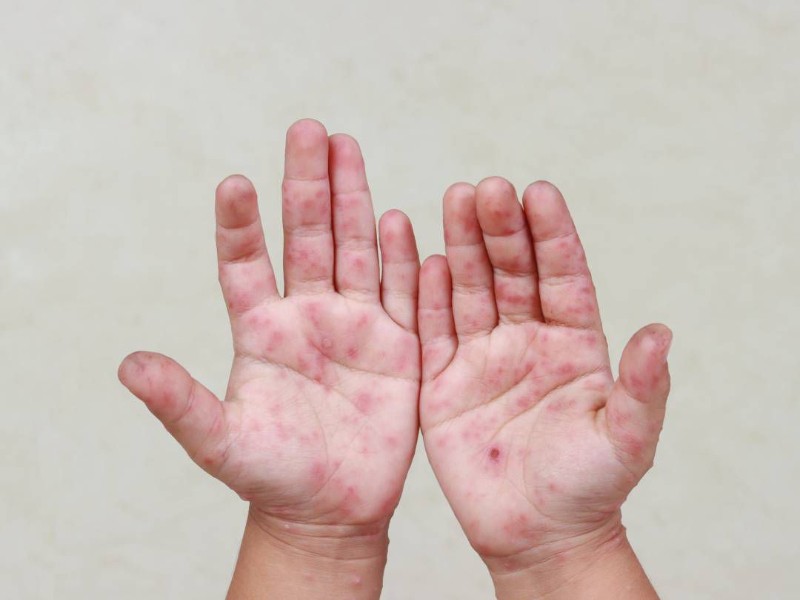 Confirman casos de virus Coxsackie en Tuxpan