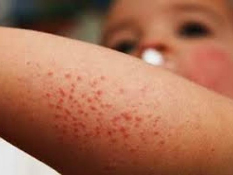 Confirman cuatro casos de sarampión en Nayarit; hay 12 más sospechosos