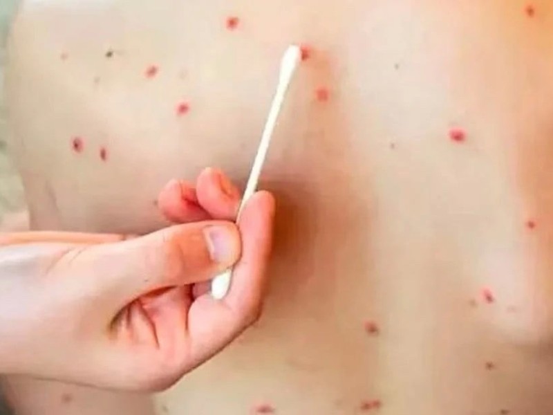 Confirman en Querétaro 9 casos de sarampión, 4 fueron hospitalizados