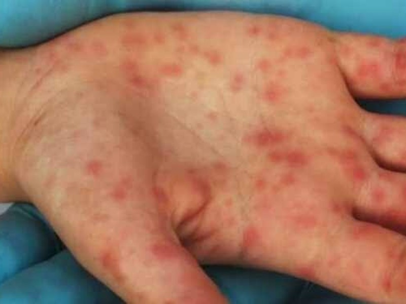 Confirman quinto caso de viruela símica en Nayarit