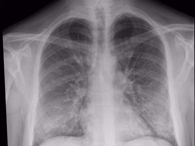 Covid-19 podría causar anomalías pulmonares meses después del contagio