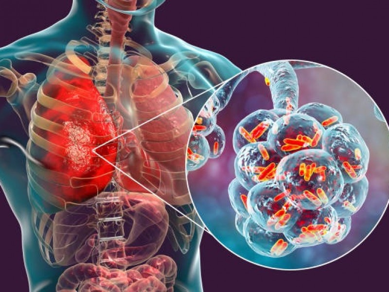 Dan atención oportuna a 408 casos de tuberculosis con tratamiento