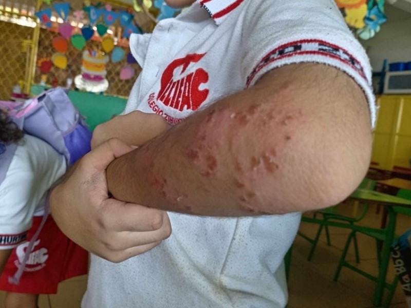 Denuncian brote de enfermedades cutáneas en colegio privado de Zihuatanejo