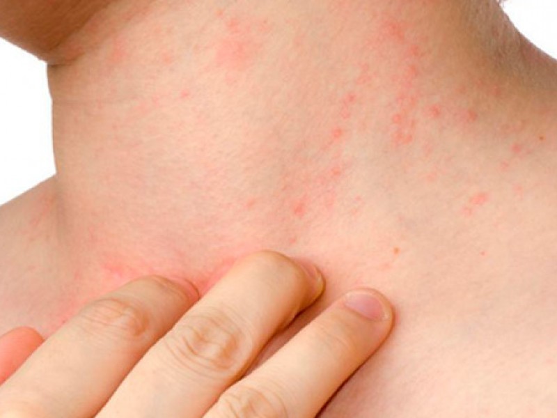 Dermatitis, un padecimiento más común en la actualidad