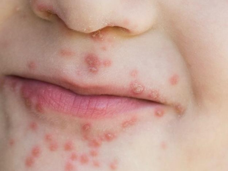 Detectan 42 casos de virus Coxsackie en infantes de Zacatecas