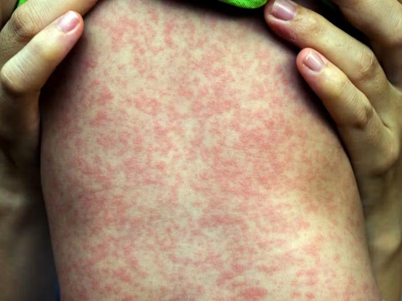 Detectan brote de sarampión en Cancerología; hay dos decesos
