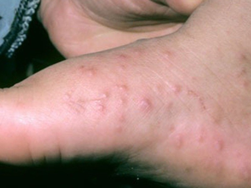 Detectan ocho nuevos brotes de virus Coxsackie en Zacatecas; suman 166 casos Detectan ocho nuevos brotes de virus Coxsackie en Zacatecas; suman 166 casos