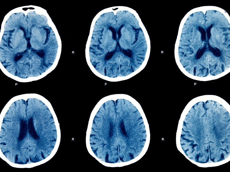 Detectan posible daño cerebral en paciente con rabia humana
