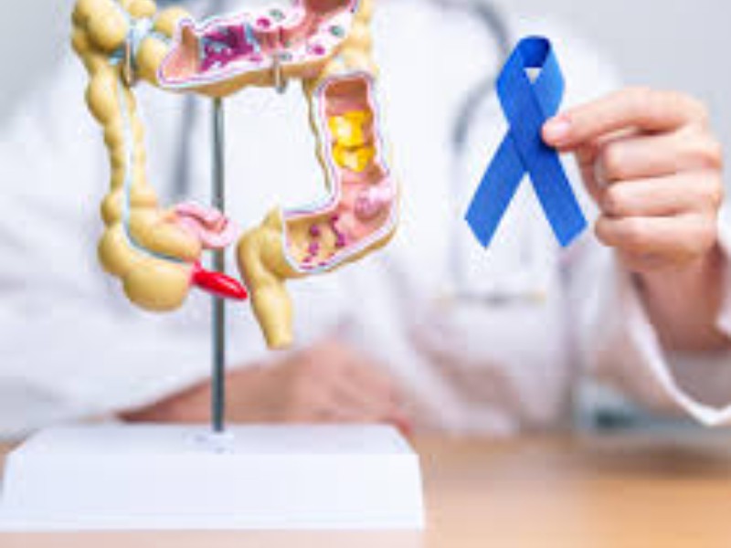 Detectar a tiempo el cáncer de Colon puede salvar vidas