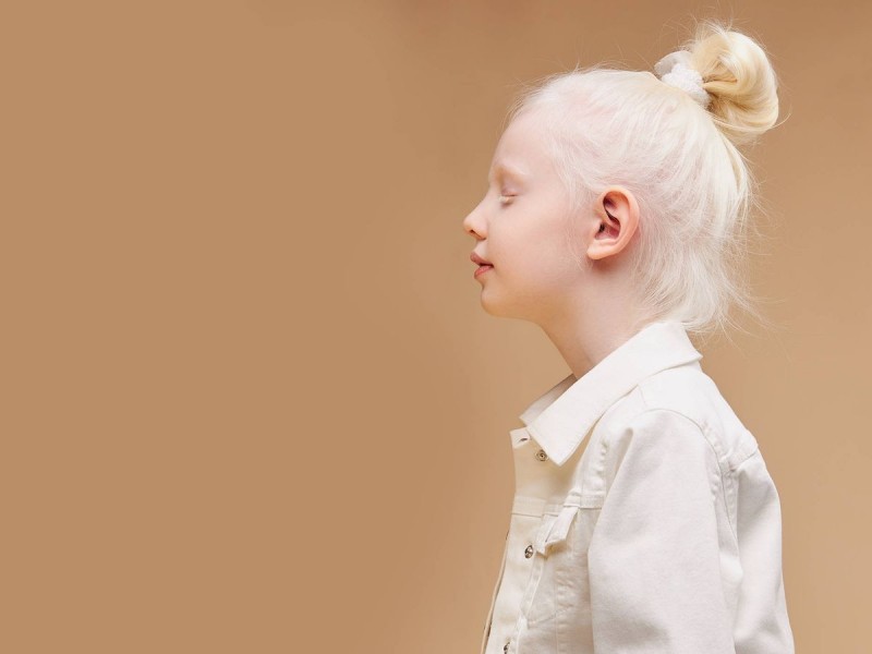 Día Internacional de sensibilización sobre el albinismo