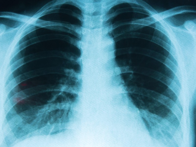 Día Mundial de la Lucha contra el Cáncer de Pulmón