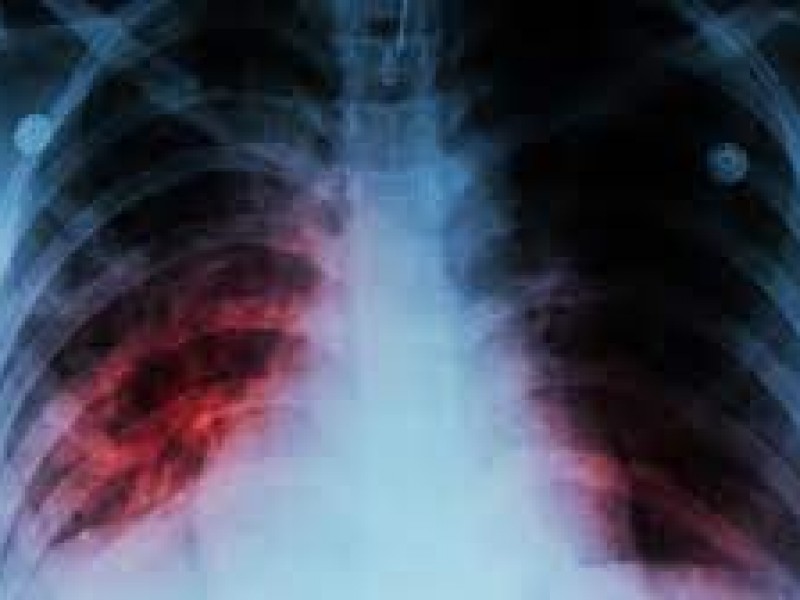 Día mundial de la tuberculosis, empatada al Covid-19 en letalidad