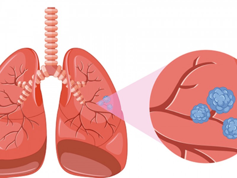 Día Nacional del Cáncer de Pulmón; importancia de buenos hábitos