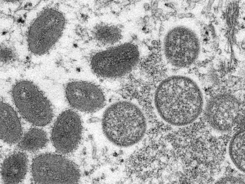EEUU reporta primera muerte relacionada a la viruela símica