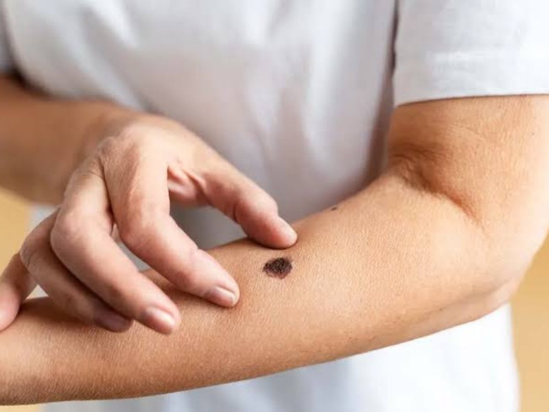 El cáncer de piel se detecta a más temprana edad