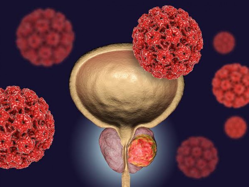 Eliminar tabúes, la clave contra el cáncer de próstata