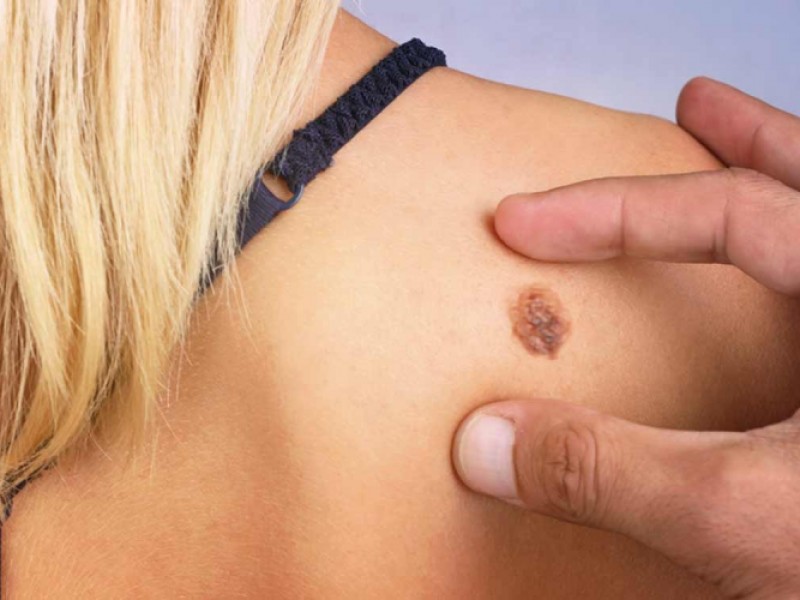 Emiten recomendaciones para prevenir melanomas