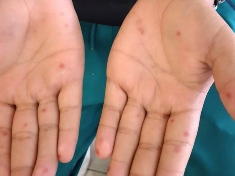 Escuelas de San Pablo Etla reanudan clases tras brote de virus coxsackie